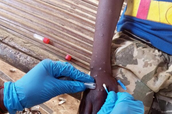 Variole Mpox : le ministère de Santé active le Centre des opérations d’urgence sanitaire